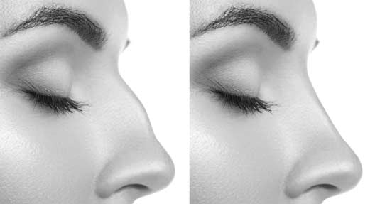 Chirurgie du nez Avant Apres Chirurgie du nez Avant Apres