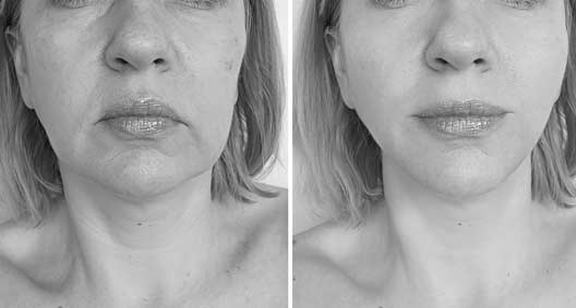 Lifting Avant Apres Lifting Avant Apres