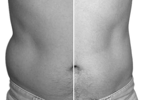Cryolipolyse Gommez Vos Poignees D Amour Lille Dr Andre Elia