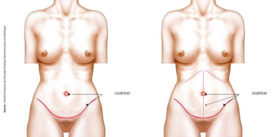 Les cicatrices de l'abdominoplastie chez le dr Elia à Lille