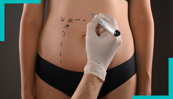 Abdominoplastie ou Lifting du ventre | Dr Elia | Lille & Arras
