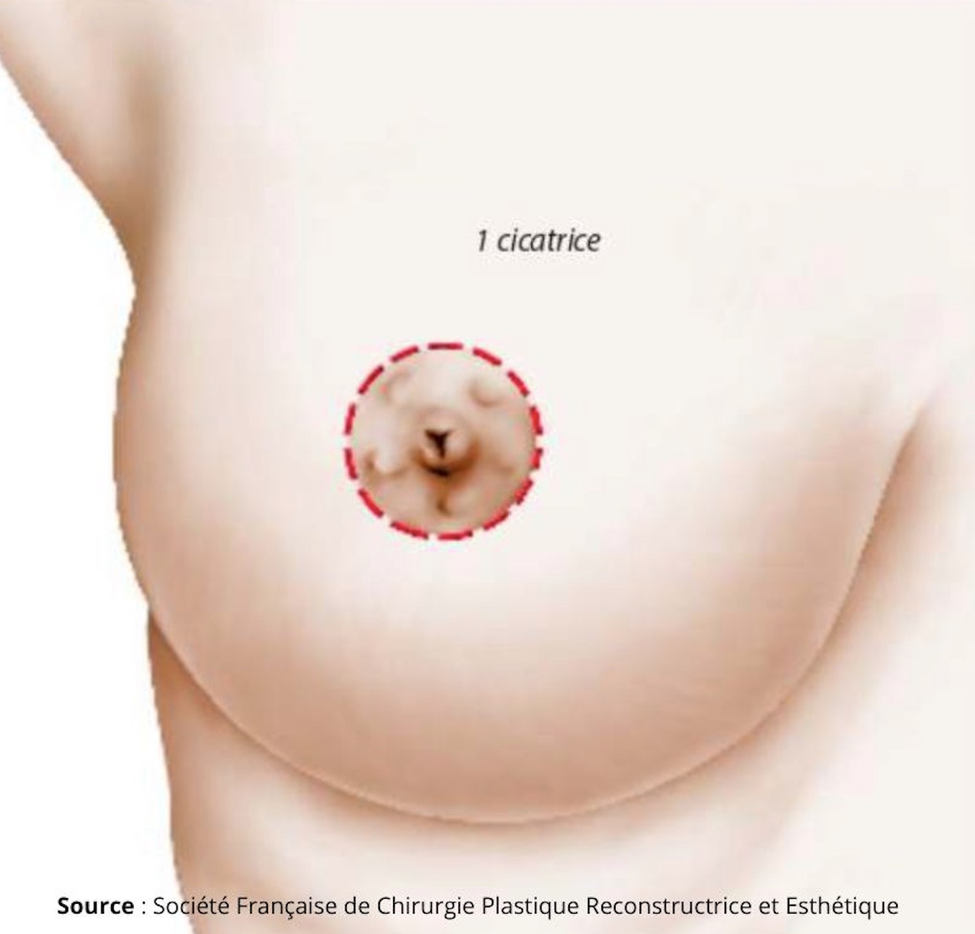 Cicatrise ptôse mammaire à Lille par le dr Elia